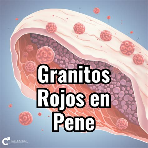 granitos en el oene|Qué hacer si notas granos en el pene